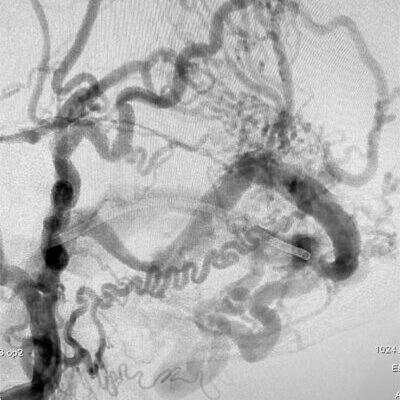 Lateral Angiogram of Dural AVF Prior to coiling