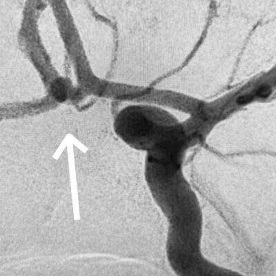 Angiogram of Acom artery aneurysm prior to coil placement