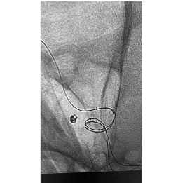 Angiogram of PC400 placement in Acom Artery Aneurysm with balloon catheter shown in parent vessel
