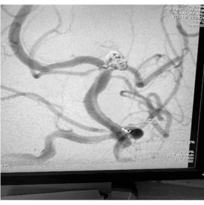 Angiogram of Basilar Tip Aneurysm post coiling