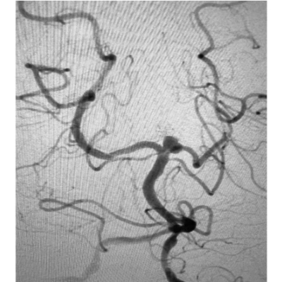 Angiogram of Basilar Tip Aneurysm prior to coiling