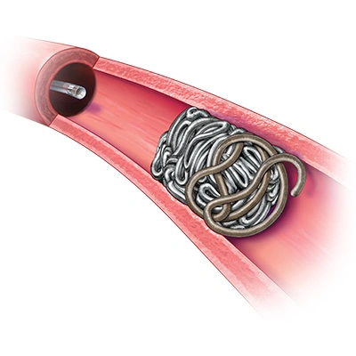 Illustration of Deployment of PAC400 behind POD400 within a vessel in the body