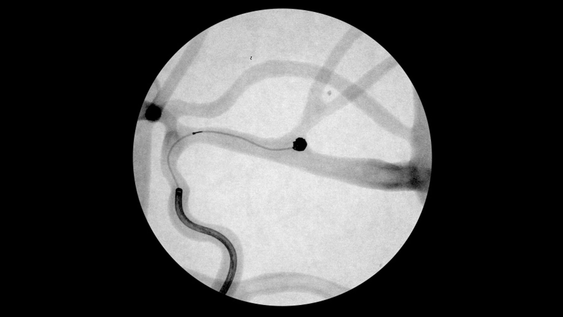 Angiogram of a Small Aneurysm Framed with SMART COIL