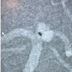 Animated Angiogram of PX Slim placed at the neck of the aneurysm and delivery of PC400 into the aneurysm