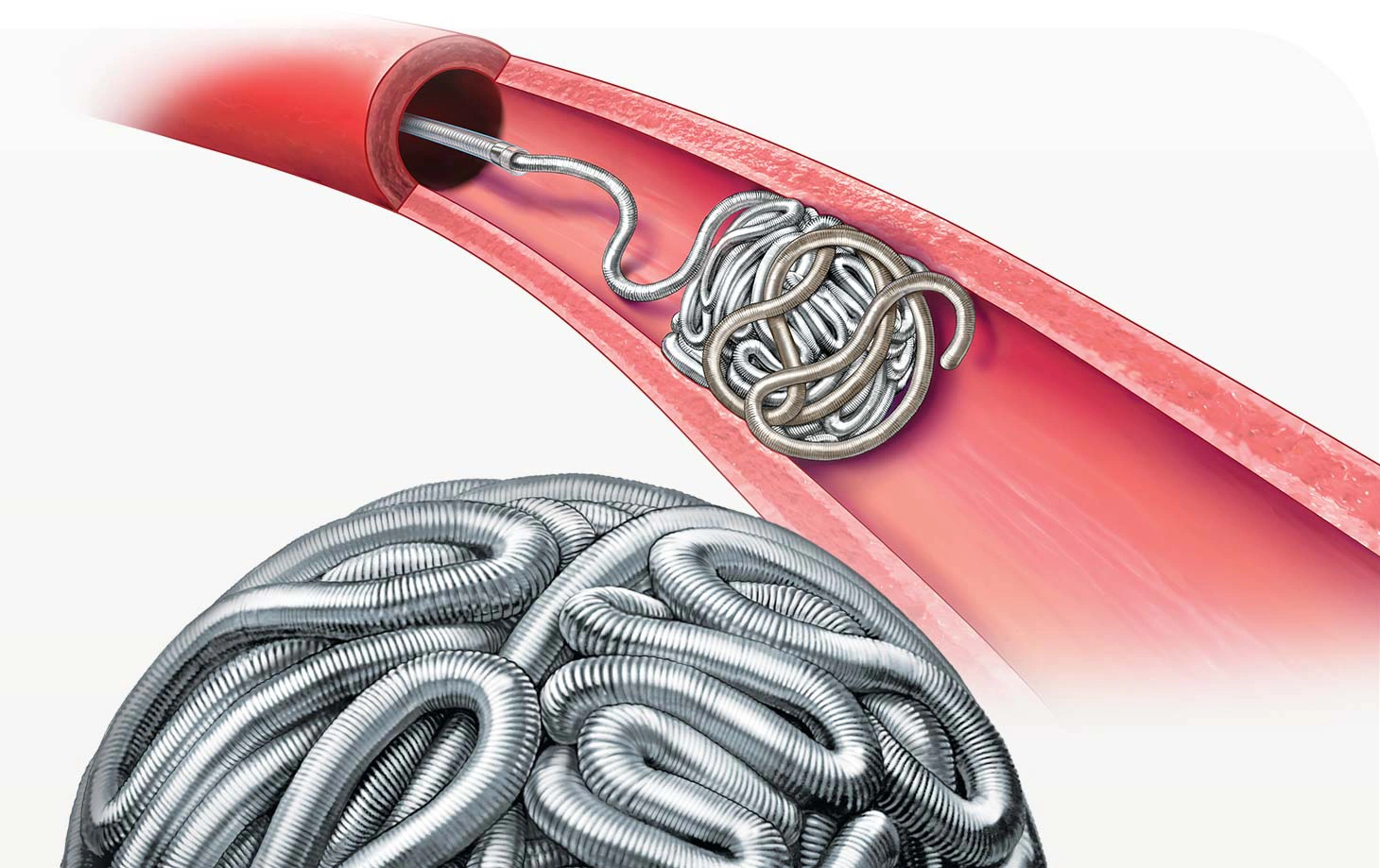 Illustration of neuro embolization products consisting of PC 400 Coiled and packed into a sphere and pod400 & pac400 in a vessel