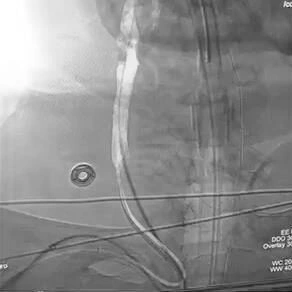 Angiogram of BMX 96 tracking pathway from the radial artery into the common carotid artery