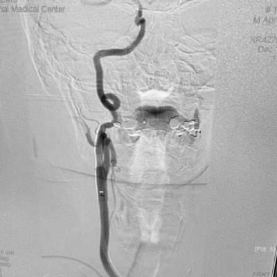 Angiogram of BMX 81 in the common carotid artery post stent placement
