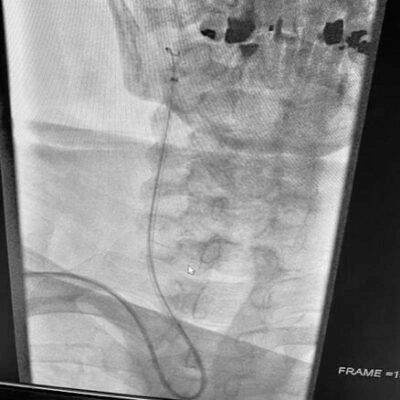 Angiogram of BMX 81 tracking into the common carotid artery