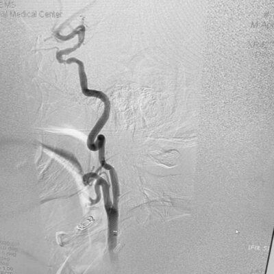 Angiogram of BMX 81 placed in the common carotid artery prior to stent placement