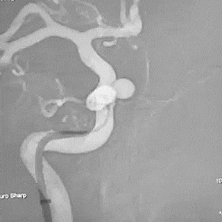 Angiogram of BMX 81 tracking over a 5 F Select Catheter into the horizontal petrous segment