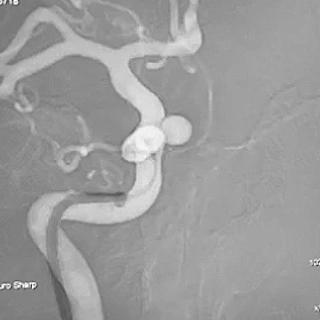 Angiogram of BMX 81 placed into the horizontal petrous segment