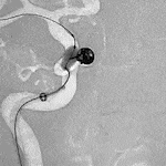 Animated Angiogram of delivery of PC400 into an aneurysm with a balloon inflated