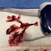 Blood clot on white towel removed from pulmonary vasculature with Lightning Flash