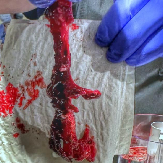 Blood clot on white towel, removed with Lightning Flash
