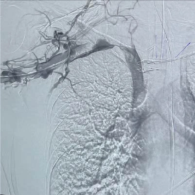 Angiographic image of subclavian vein with limited blood flow
