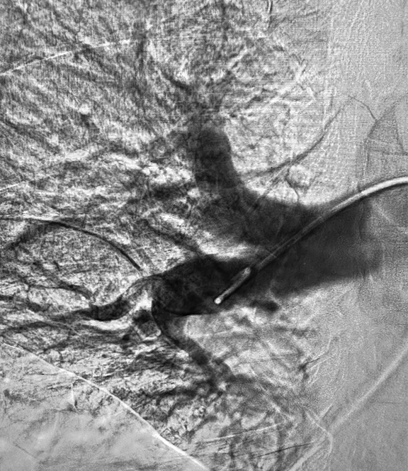 ANGIOGRAM OF RESTORED BLOOD FLOW IN LUNGS