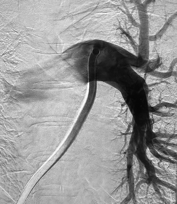 ANGIOGRAM OF RESTORED BLOOD FLOW IN LUNGS