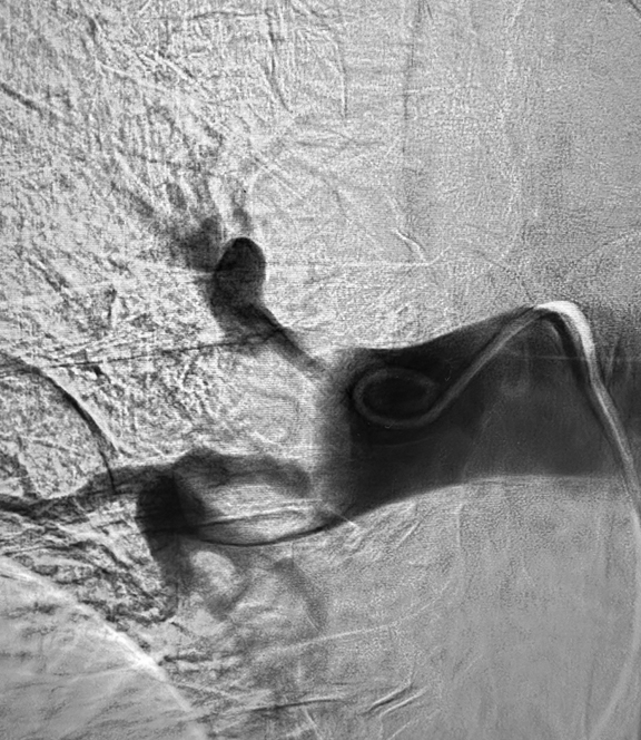 ANGIOGRAM OF BLOOD CLOT IN LUNGS