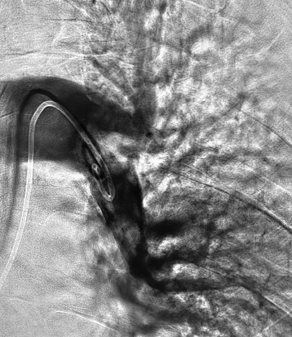 ANGIOGRAM OF BLOOD CLOT IN LUNGS