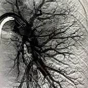 Angiographic image of left lung post computer-aided thrombectomy with Lightning Flash