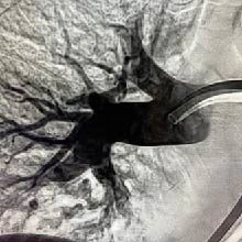 Angiographic image of right lung post computer-aided thrombectomy with Lightning Flash