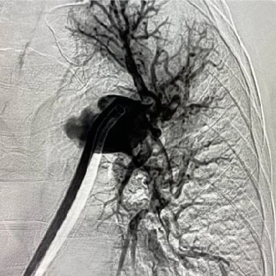 Angiographic image of left lung with pulmonary embolism