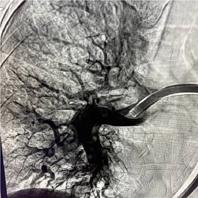 Angiographic image of right lung with pulmonary embolism