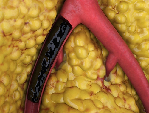Illustration of blood clot in artery