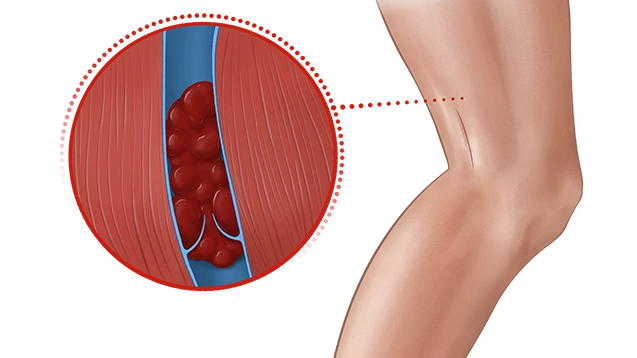 Deep Vein Thrombosis