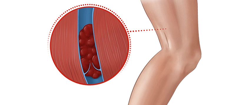 Illustration of deep vein thrombosis in the leg