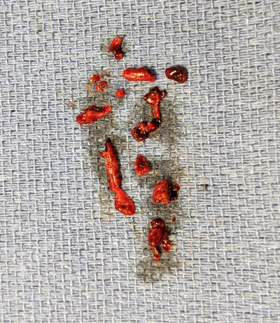 Blood clot on blue towel removed from SMA with Lightning Bolt 7
