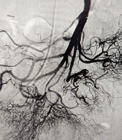 Angiographic image of restored blood flow through Superior Mesenteric Artery post thrombectomy with Lightning Bolt 7