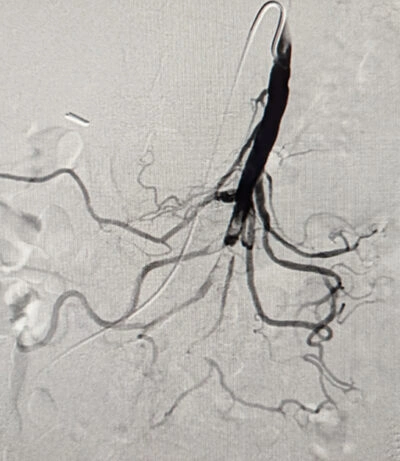 Angiographic image clot blocking blood flow in Superior Mesentaric Artery