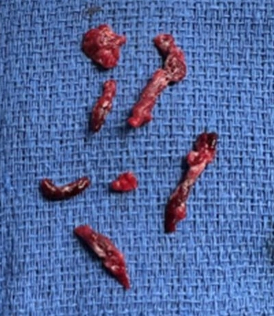 Image of blood clots on blue towel removed from tibial artery with Lightning Bolt 7