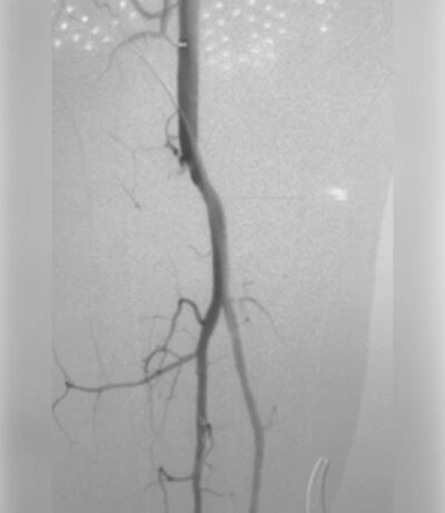 Angiographic image shows patent blood flow through tibial artery post thrombectomy with Lightning Bolt 7