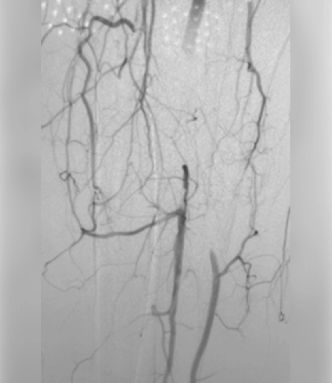 Angiographic image shows occlusion of the tibial artery prior to thrombectomy