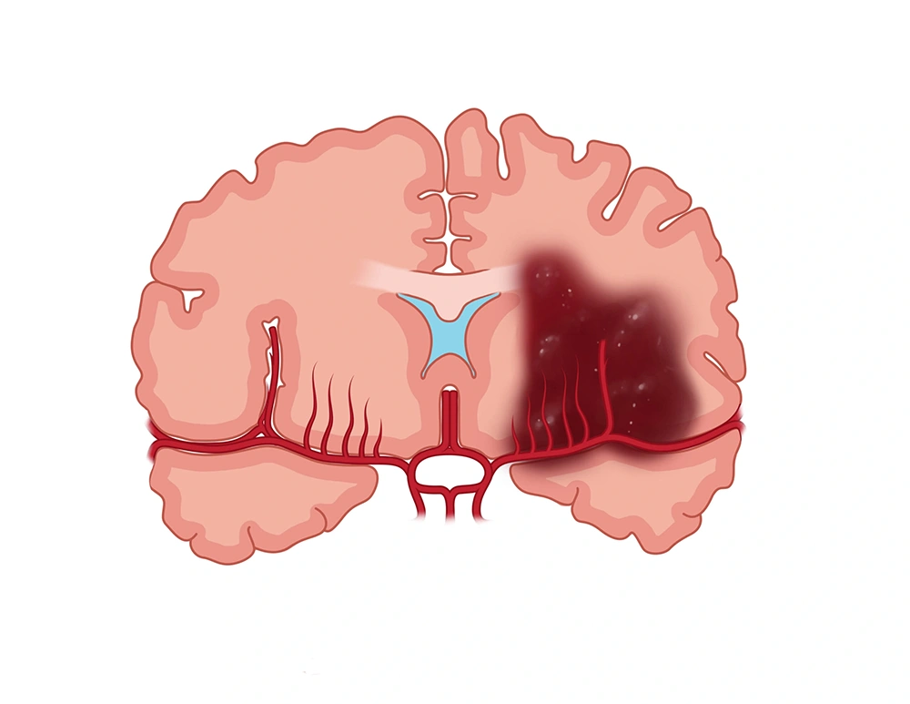 Illustration of the brain and the impact of a hemorrhagic stroke