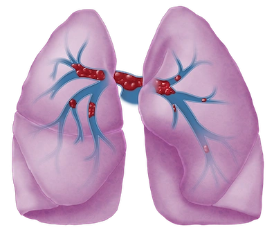 Illustration of a pulmonary embolism in the lungs