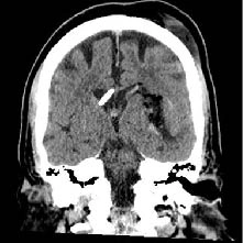 CT Scan post Intracerabral hemorrhage evacuation with Artemis