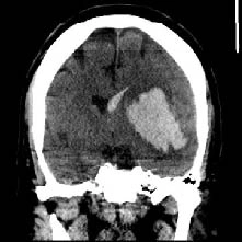 CT Scan of Intracerebral hemorrhage (ICH)