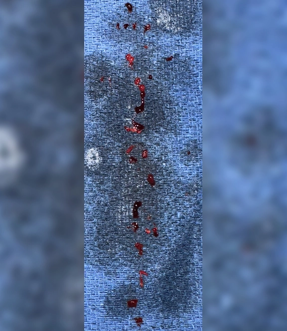 Blood clots on a blue towel