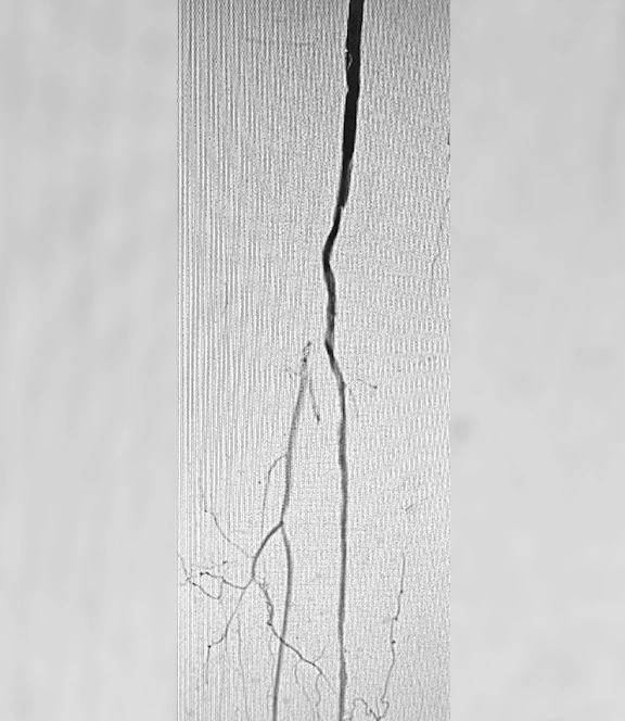 Angiogram of occluded vessel