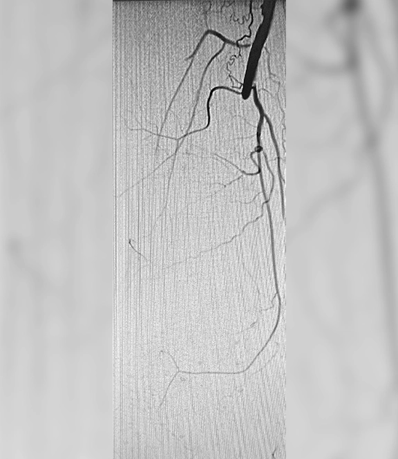 Angiogram of restored blood Flow
