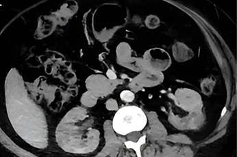 Angiogram showing bilateral renal artery occlusion