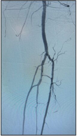 Post-thrombectomy angiogram of left anterior tibial and tibioperoneal