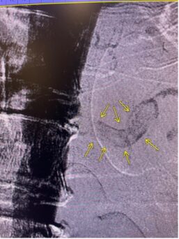 Initial Angiograms presenting occlusion to left renal artery