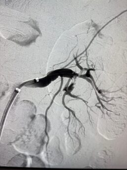 Focused angiogram of left renal artery after the first pass