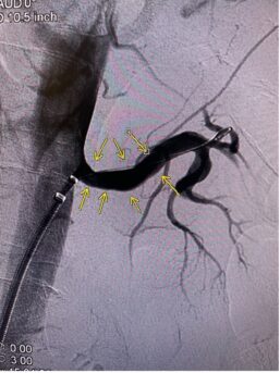 Post intervention of left renal artery showing restored flow