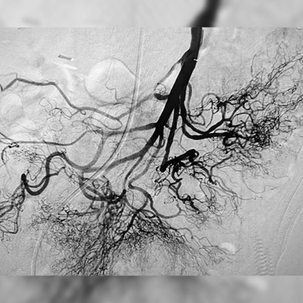 angiogram of cleared blood vessel