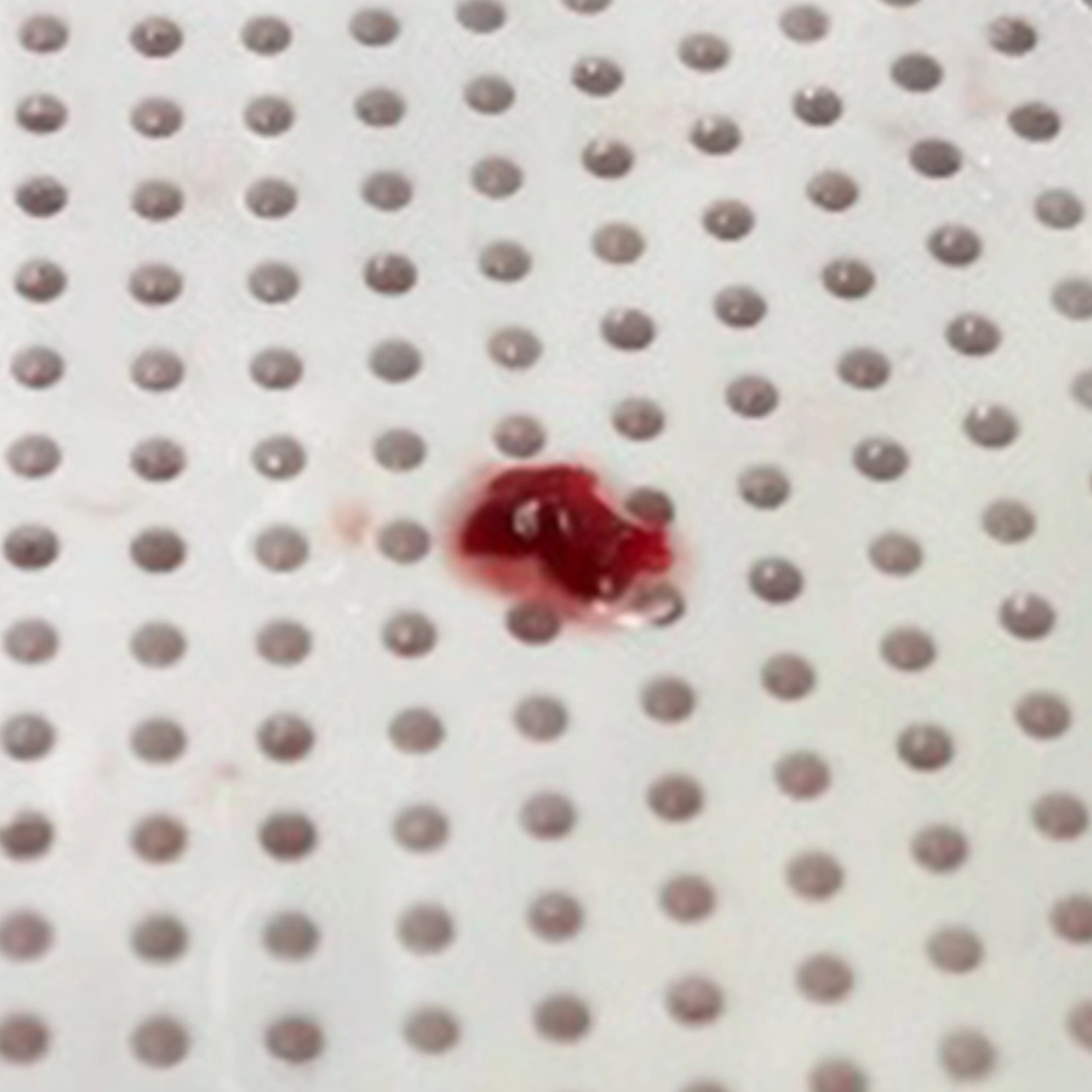 blood clot removed using Lightning Bolt 6X